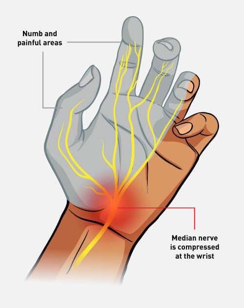 carpal-tunnel-syndrome-illustration
